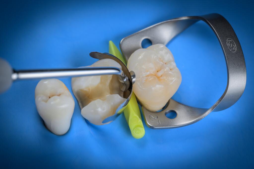 Contact-Shaper-Distal1-1024x683.jpg